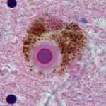 Microscopic view of tissue showing a singular cell with a violet-stained nucleus surrounded by brown granular material, set against a backdrop of pink-streaked cellular matter.